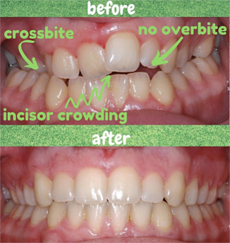 palatal expander